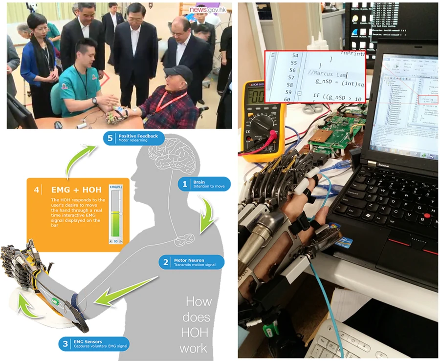Hand of Hope — EMG-driven hand rehabilitation exoskeleton in use